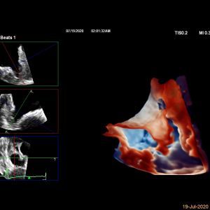 CVx Workshop: Advanced 3D Echocardiography