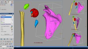CT Lunch & Learn Webinar 4: CT Trauma with Advanced Visualization