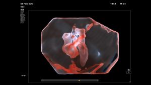 First Trimester Cardiology Ultrasound: Top Tiny Ticker Tricks 