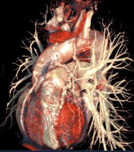 Philips & Bayer Webinar: CT Cardiac with Advanced Visualization
